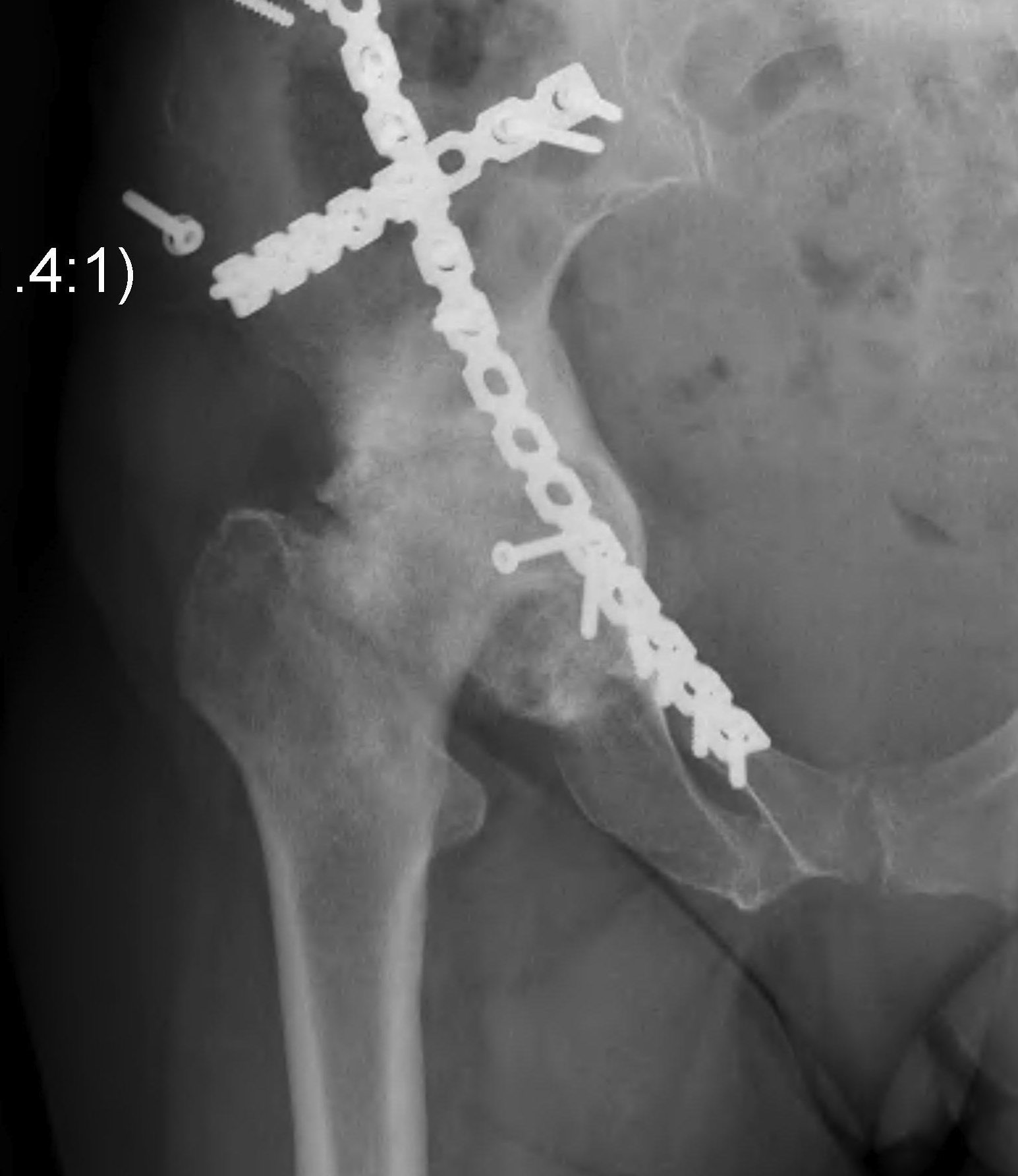 Hip OA post Acetabular Fracture